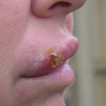 cold sore