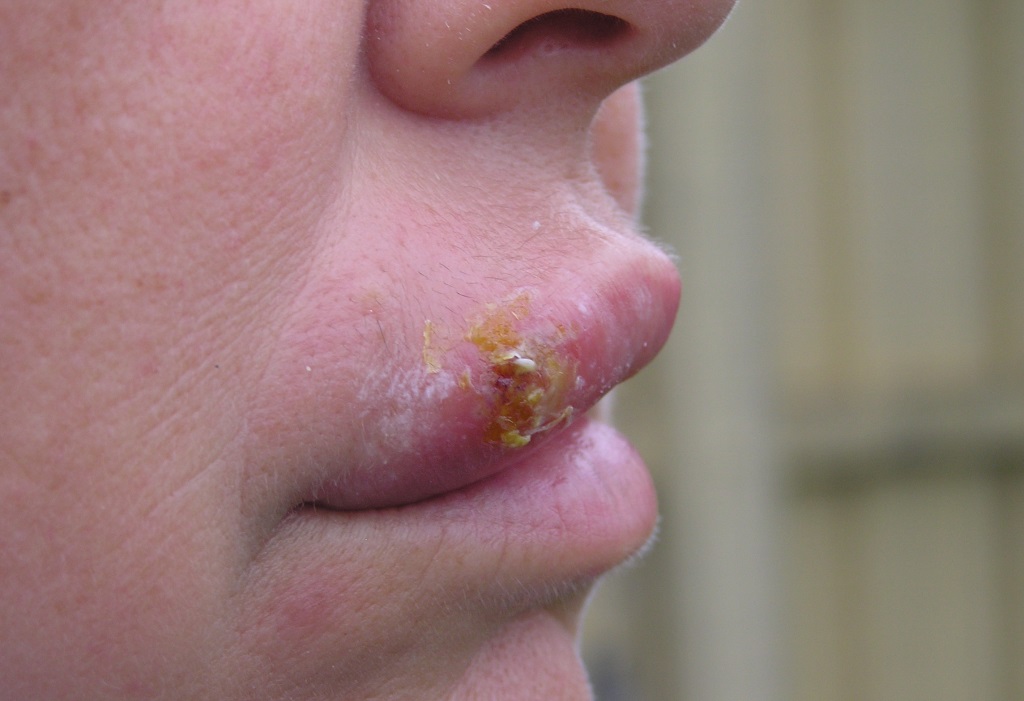 How to find the best medicine for cold sore