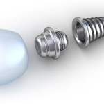 implant
